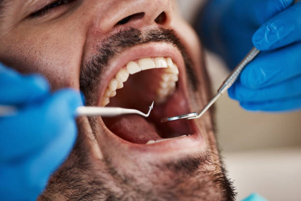 Best Emergency Wisdom Tooth Extraction in Douglass, KS